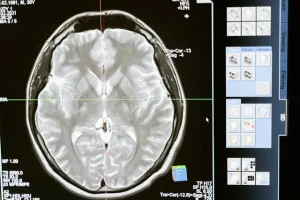 meningitis 수막염 감염증